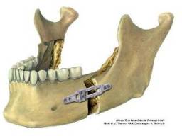 Osteotomie des Unterkiefers