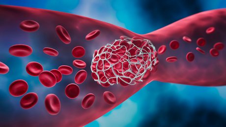 Periphere arterielle Verschlusskrankheit der Gefäße