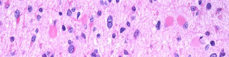 Hirntumor