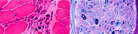 Muskel-/Nervbiopsie